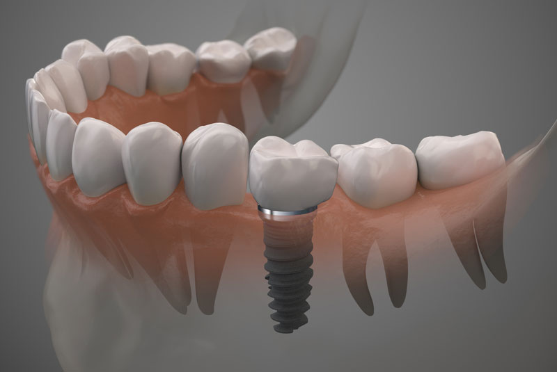 dental implants graphic