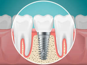2d graphic of a dental implant