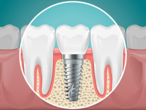 2d graphic of a dental implant