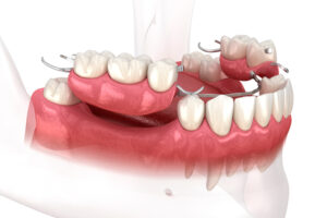 Close-up 3d image of a dental implant.