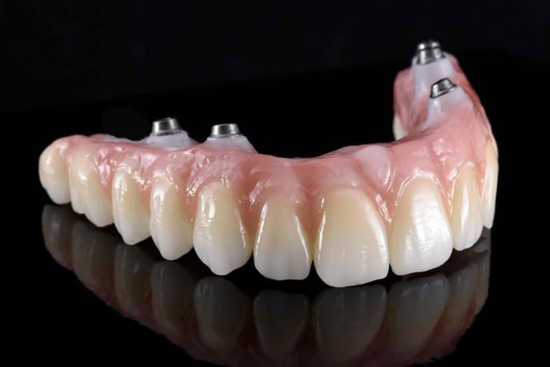 a zirconia full arch dental implant bridge prosthesis.
