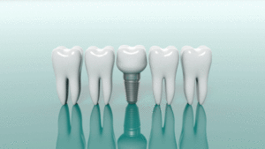 3d model of 4 teeth with a dental implant in the middle of them