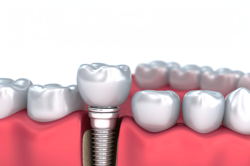 Medically accurate 3D illustration of a Dental Implant