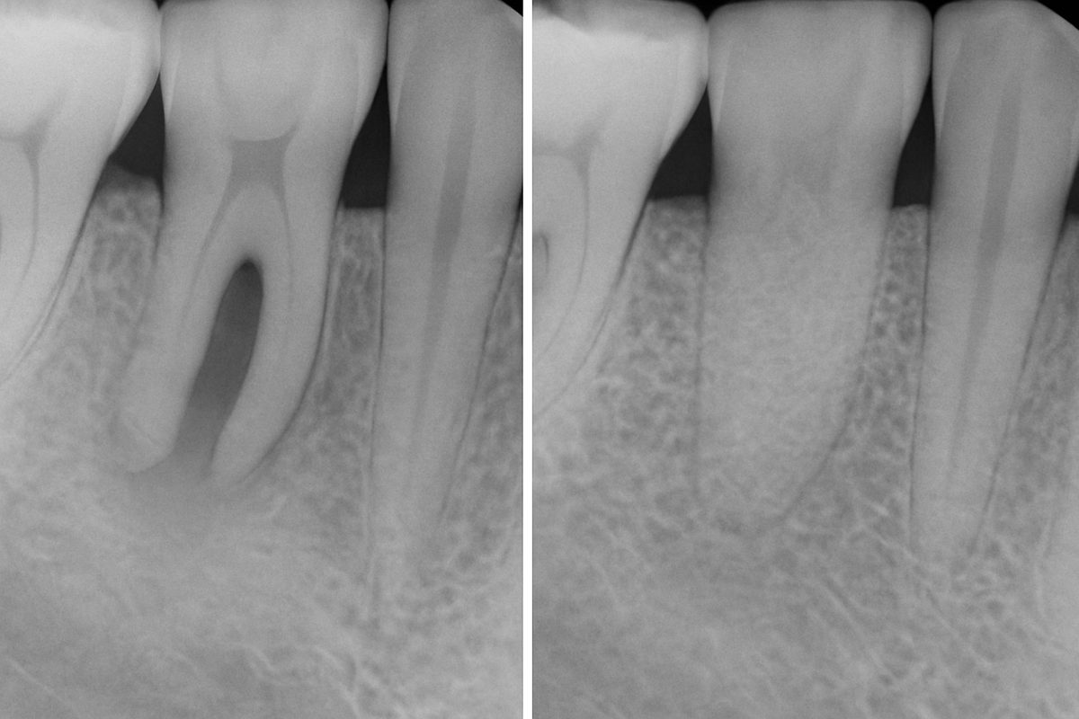 A before-and-after image demonstrating dental implant grafting results. The "before" side showing bone loss, and the "after" side displaying restored bone volume ready for implant placement. No text on image.
