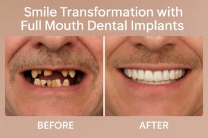 Image showcasing a before-and-after transformation of a patient's smile with full mouth dental implants. The "before" side shows missing or damaged teeth, and the "after" side displays a complete, natural-looking set of teeth, highlighting the aesthetic and functional benefits of the procedure. Text on image states "Smile Transformation with Full Mouth Dental Implants".