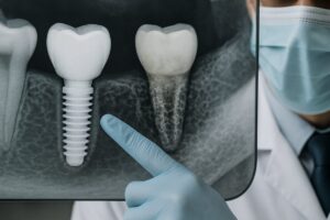 A close-up image showing a dentist pointing to a healthy dental implant integrated into the jawbone, contrasted with an unhealthy implant affected by peri-implantitis. No text on image.